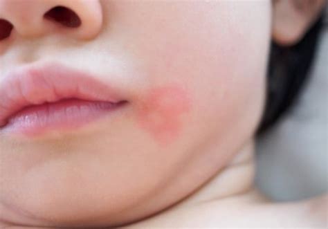 3 Cara Cepat Menghilangkan Bintik Merah Di Wajah Bayi
