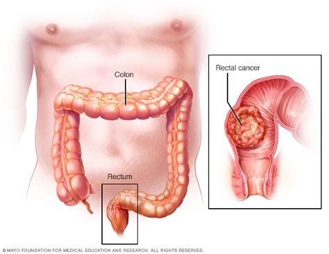 Rectal Cancer Symptoms And Causes 2022