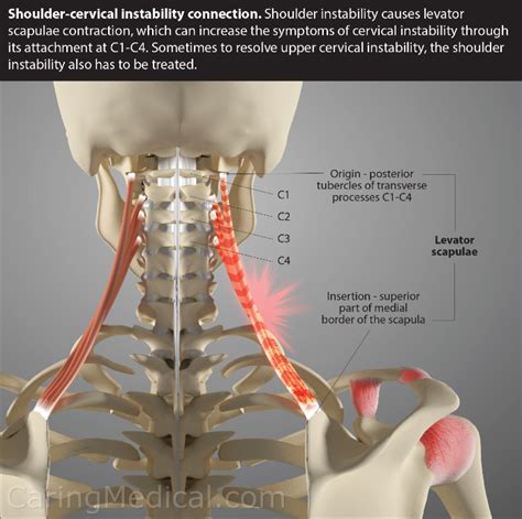 Is Neck Instability Causing Your Shoulder Pain Caring Medical Florida