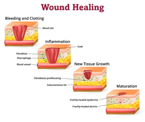 Delayed Wound Healing In Children With Cancer Together By St Jude™