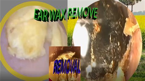 How To Removal Earwax At Home With Hydrogen Peroxide Ear Wax Removal