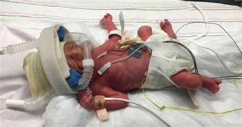 The Story Of Our Preemie In The Nicu Of Northside Hospital