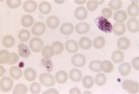 Free Picture Photomicrograph Shows Mature Plasmodium Malariae