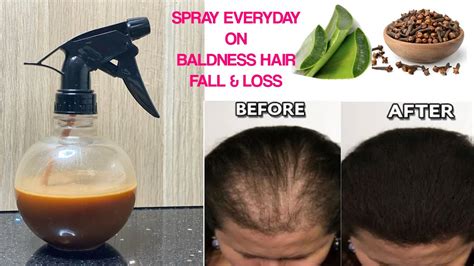 Mix Clove Seeds And Aloe Vera To Treat Baldness Hair Loss Fall And Alopecia