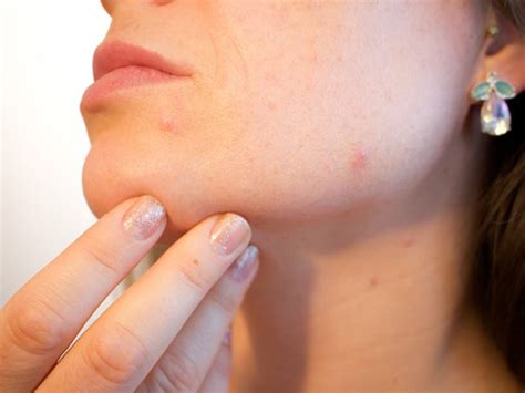Acne Treatment Which Is The Best One For Mild Acne