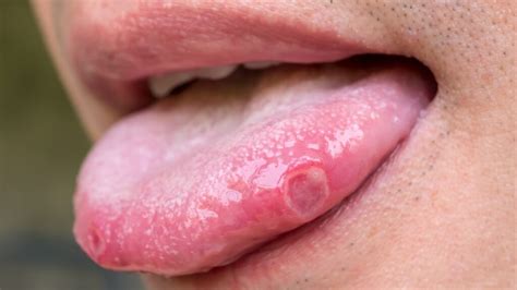 Pimples On Tongue Under On Tip Side Or Back And Getting
