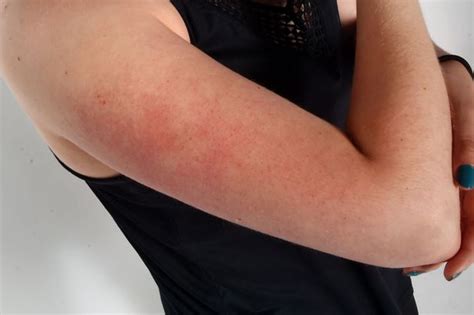 What Are The Red Bumps On The Top Of Your Arms And When To See A Doctor