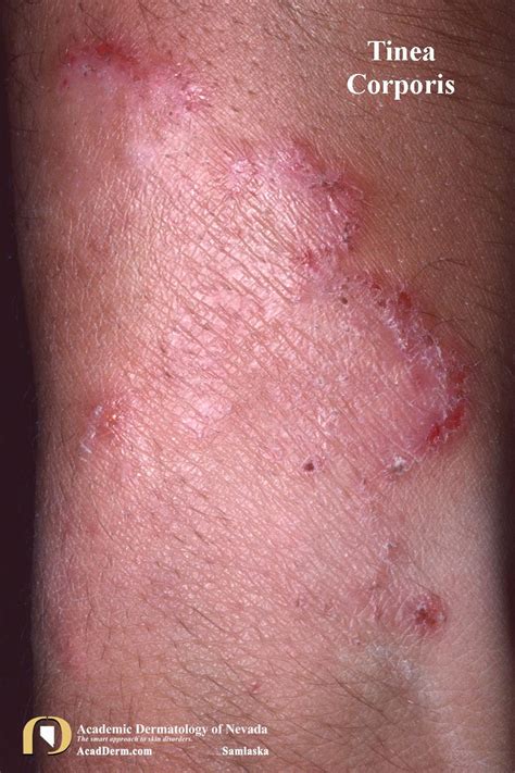 Tinea Corporis Ringworm Tinea Circinata Academic Dermatology Of