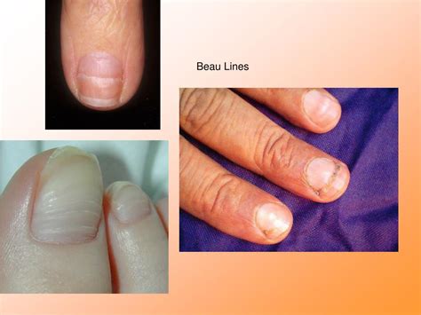 Ppt The Most Commonly Reported Nail Conditions Seen By Podiatrists