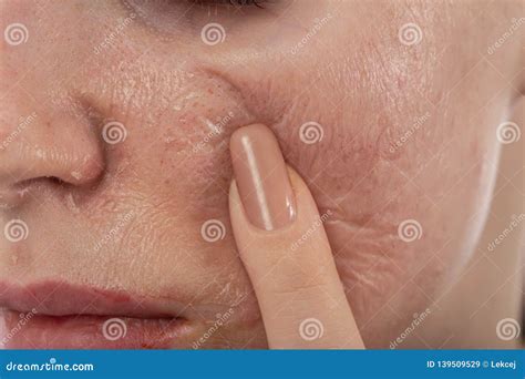 Skin After Peeling Stock Image Image Of Condition Surgery 139509529