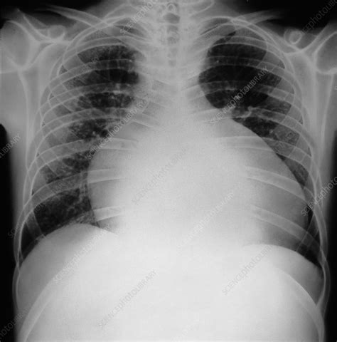 Cardiomyopathy Chest X Ray Stock Image C0541475 Science Photo
