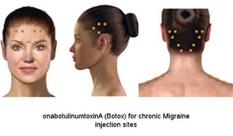 Botox Headache Injection Sites