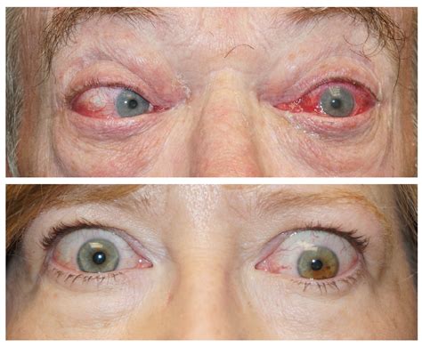 My swollen nose is not at all. CRSTEurope | Managing Thyroid Eye Disease