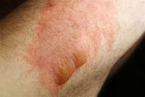 Natural Remedies To Help A First Degree Burn Heal