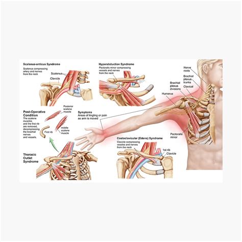 Medical Illustration Detailing Thoracic Outlet Syndrome Photographic