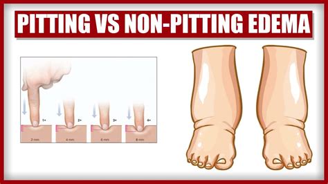Scale For Pitting Edema