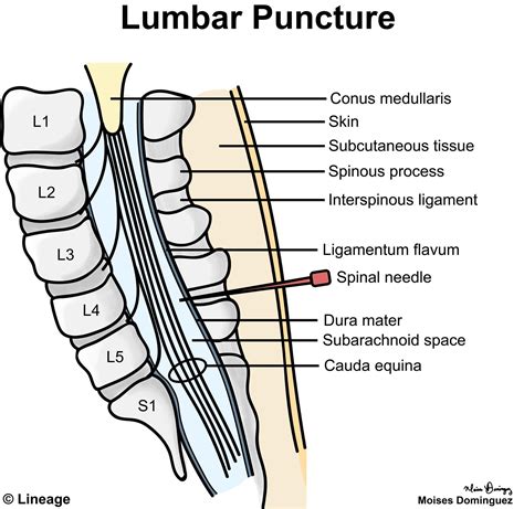 Lumbar Puncture Neurology Medbullets Step 1