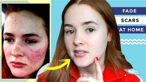 How I Cleared My Acne Scars At Home Youtube