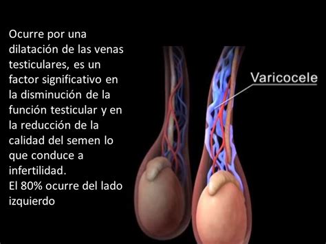 Que Es El Varicocele Y Sus Causas Kulturaupice