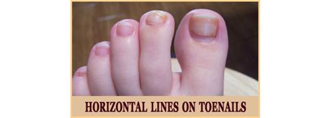 A black line or streak that appears in a nail is often from some type of injury. What causes horizontal white lines on your toenails? - Quora