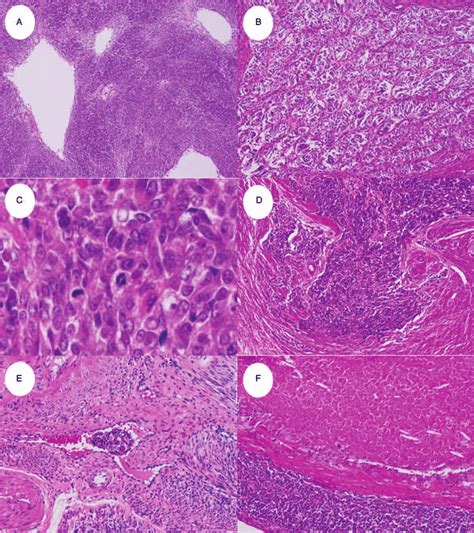 Histology Of The Uterine Tumor Resembling Ovarian Sex Cord Tumor