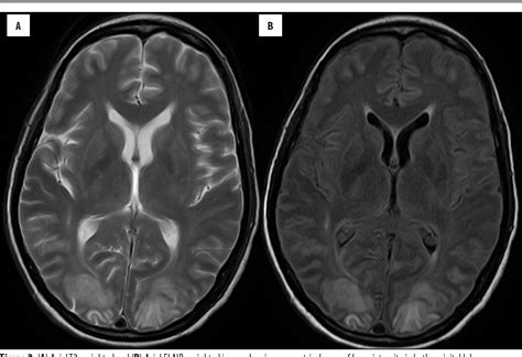 Various Imaging Manifestations Of Posterior Reversible Encephalopathy