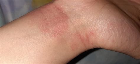 Аллергия на руках пузырьки и зуд Вопрос аллергологу 03 Онлайн