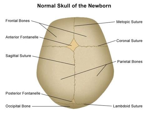 Fusion Of Suture 1 Metopic Suture At 3 Yrs 2 Sagittal Coronal