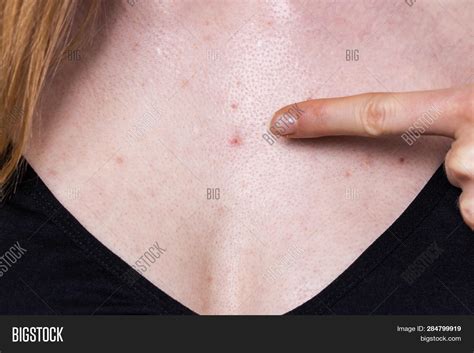 Woman Having Pimples Image And Photo Free Trial Bigstock