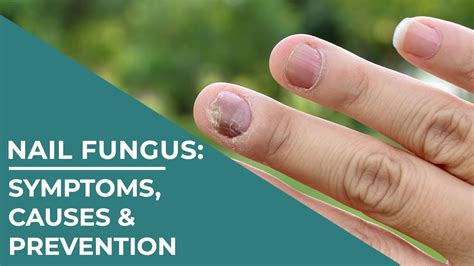 Nail Fungus Symptoms Causes And Prevention Measures Healthie Genie