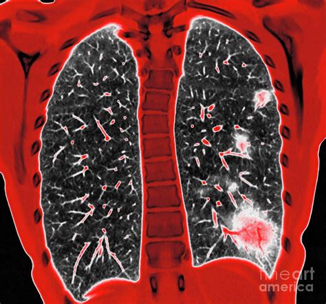Lungs Affected By Covid 19 Pneumonia Photograph By Vsevolod Zviryk