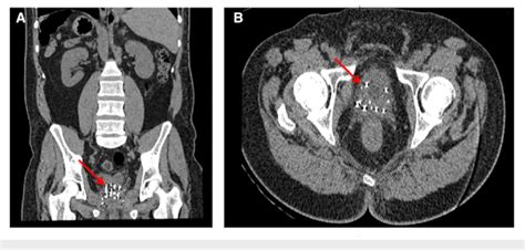 Coronal A And Axial B Ct Of The Abdomen And Pelvis Without Contrast