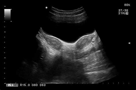 Bicornuate Uterus Mullerian Duct Anomaly Bicornuate Uterus Uterus