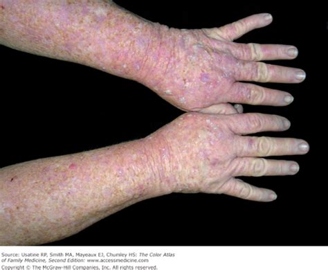 Actinic Keratosis And Bowen Disease Basicmedical Key