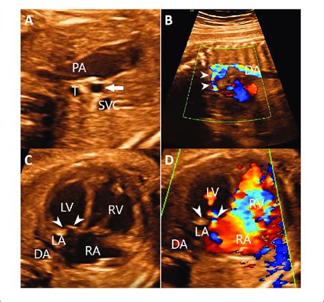 The Echocardiography Of The Fetus Identified Aorta Hypoplasia Ab