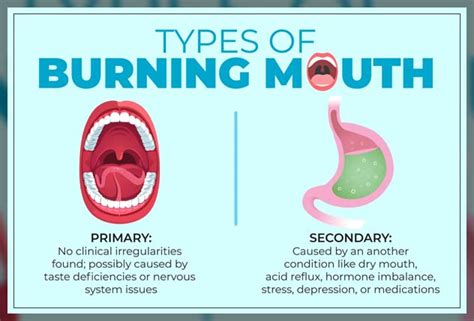 Burning Mouth Syndrome Causes And Treatment Dentist Ahmed