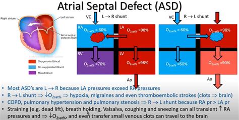 Atrial Septal Defect Asd And Patent Foramen Ovale Pfo Fittest