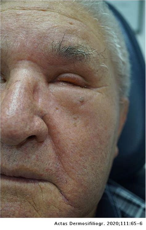 Edema Facial Con Fóvea Un Importante Diagnóstico Diferencial Actas