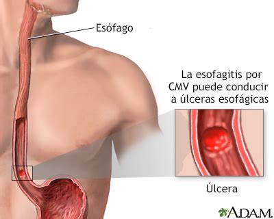 Spanish Hie Multimedia Esofagitis Por Cmv