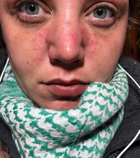 Is This Rosacea Dry Cystic Type Bumps Red Coarse And Sorrow R