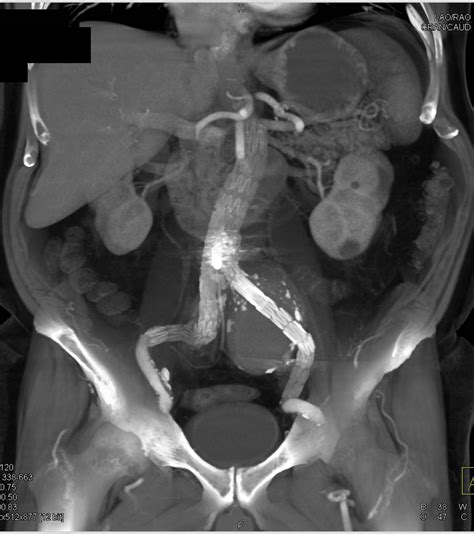 Left Common Iliac Artery Aneurysm Treated With An Endovascular Stent