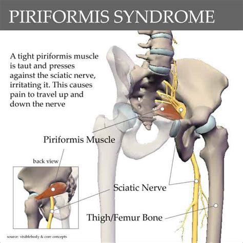 And moreover the trapezius muscle attaches onto t12. What is Sciatica? Local Santa Clara Chiropractor explains ...