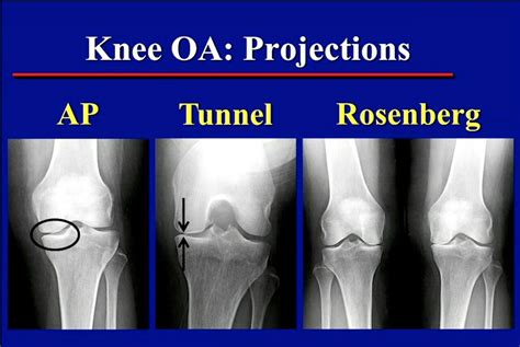 Radiographic Positioning Of The Knee