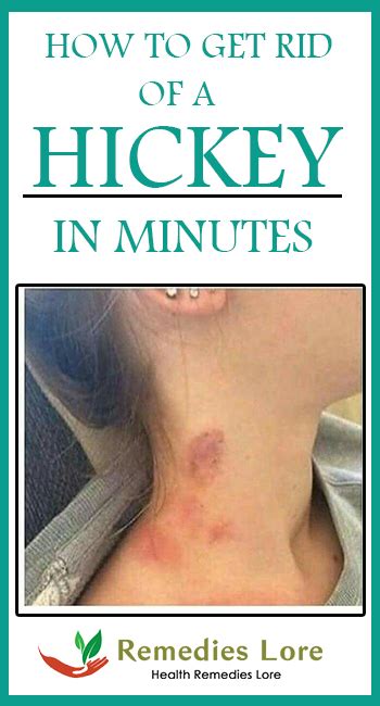30 nuggets (yes 30) 2 large chips; How to Get Rid of Hickey in Minutes - 10 DIY Methods ...