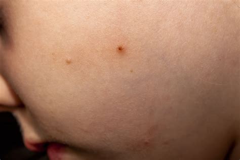 Topical For Molluscum Contagiosum Performs Well In Phase 3 Trials