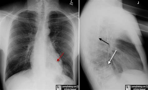 Learning Radiology Spine Sign