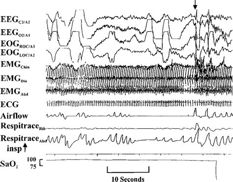 Polysomnographic Example Of Apnea In Infant With Obstructive Sleep