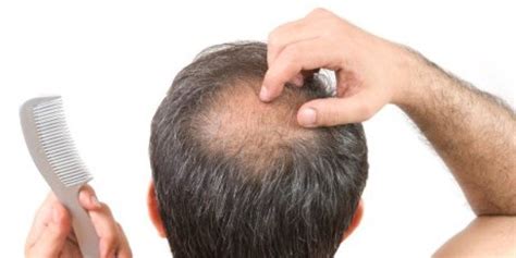 Keguguran rambut dalam kalangan lelaki dijangka lebih tinggi daripada golongan wanita. Punca Rambut Lelaki Gugur
