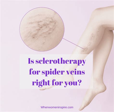 Here S How Sclerotherapy For Spider Veins Can Help When Women Inspire