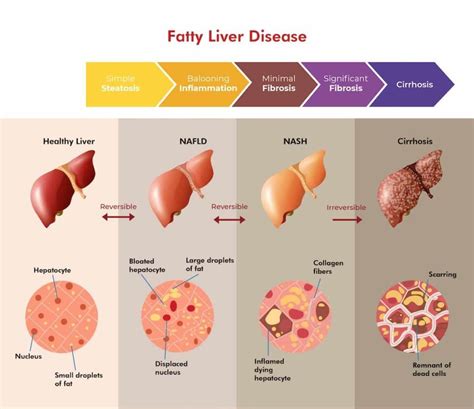 Diagnosis Fatty Liver Disease Hepatic Steatosis Because Most People